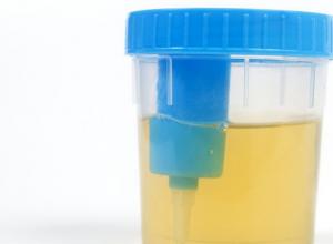Protein i urinen: vad det betyder, möjliga orsaker